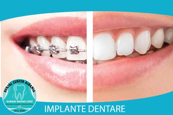 Implante dentare dhe mbjellje dhëmbi nga DENTAL CENTER LEZHA